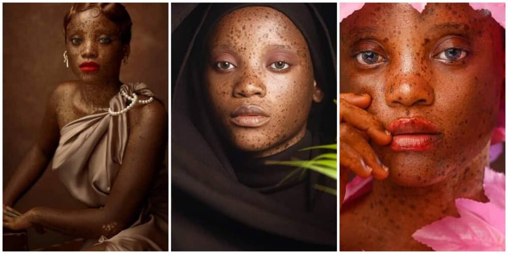 Meet the beautiful 20-year-old Nigerian model with skin condition