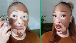 Beautiful woman with vitiligo sheds light on autoimmune disease in makeup routine video