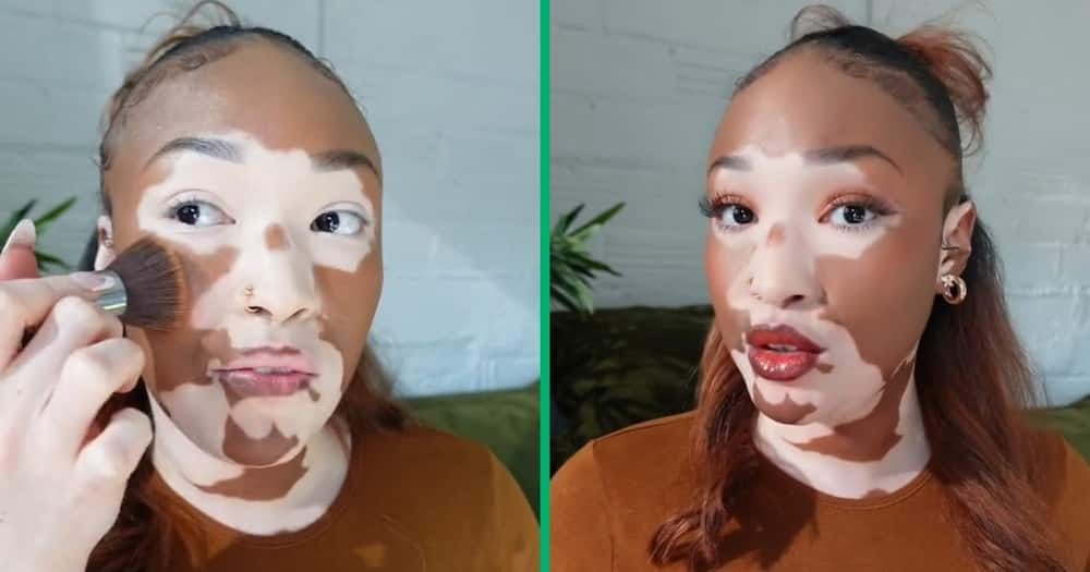 A woman with vitiligo posted a makeup video