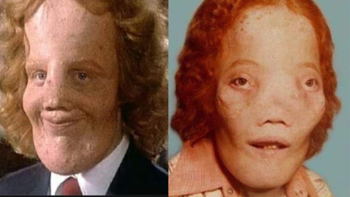 Rocky Dennis S Life Inspired Many Children Who Have Impairments
