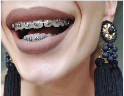 How much do braces cost in South Africa 2021? Find it out here