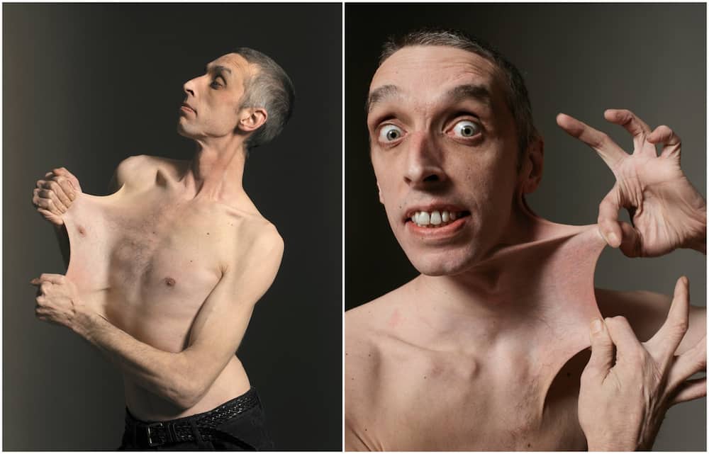 Meet Garry Turner: The man with the world's stretchiest skin - Briefly.co.za