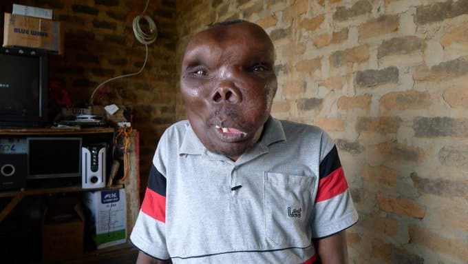 Godfrey Baguma Biography, Age, Wife, Wiki, Disease, Ugliest Man In The World