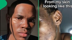Mzansi man showcases how he cleared hyperpigmentation in 20 days using Garnier products in video
