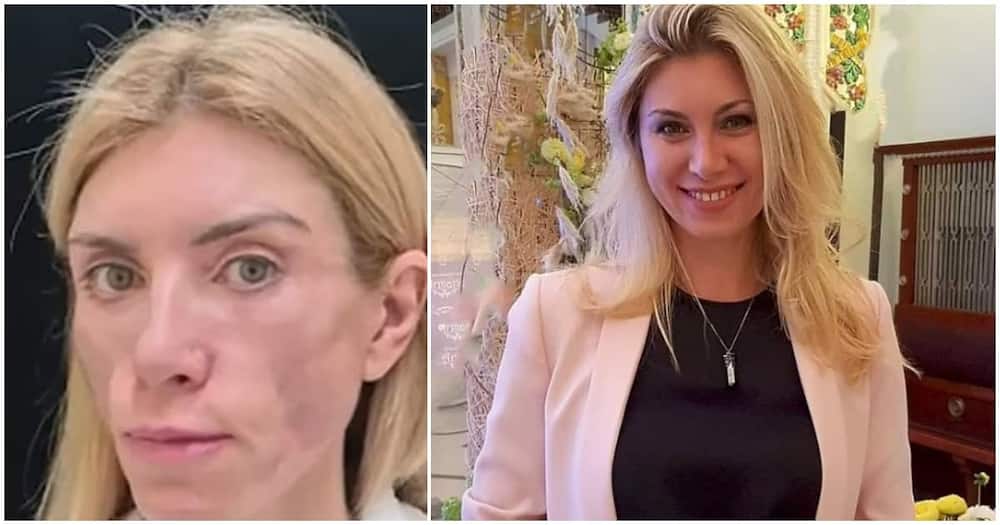 43-year-old beauty queen who cannot smile or close her eyes again after undergoing plastic surgery