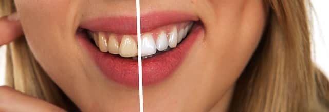 Everything you need to know about teeth whitening in South Africa