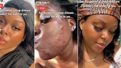 Lady who battled severe acne shares beauty routine that gave her flawless skin: "Costs less than R24"