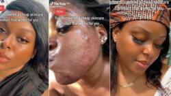 Lady who battled severe acne shares beauty routine that gave her flawless skin: "Costs less than R24"