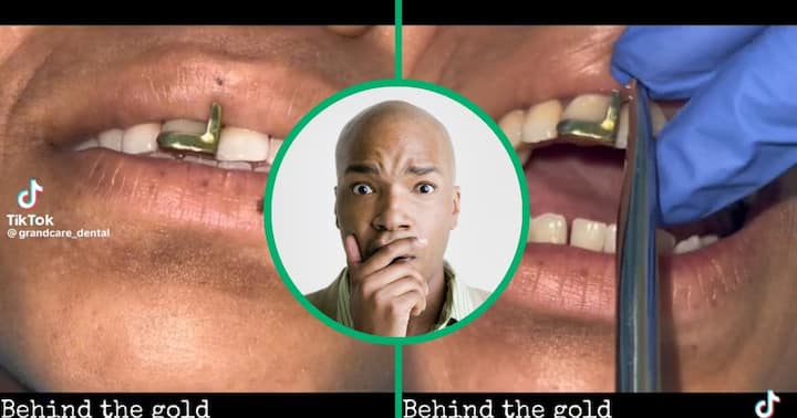 Dentist’s Video of Gold Tooth Removal Clocks 920K Views and Leaves SA ...