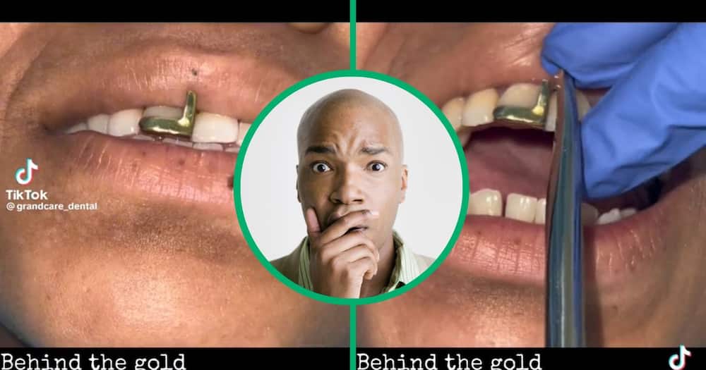 A dentist posted a TikTok video showing a gold tooth removal