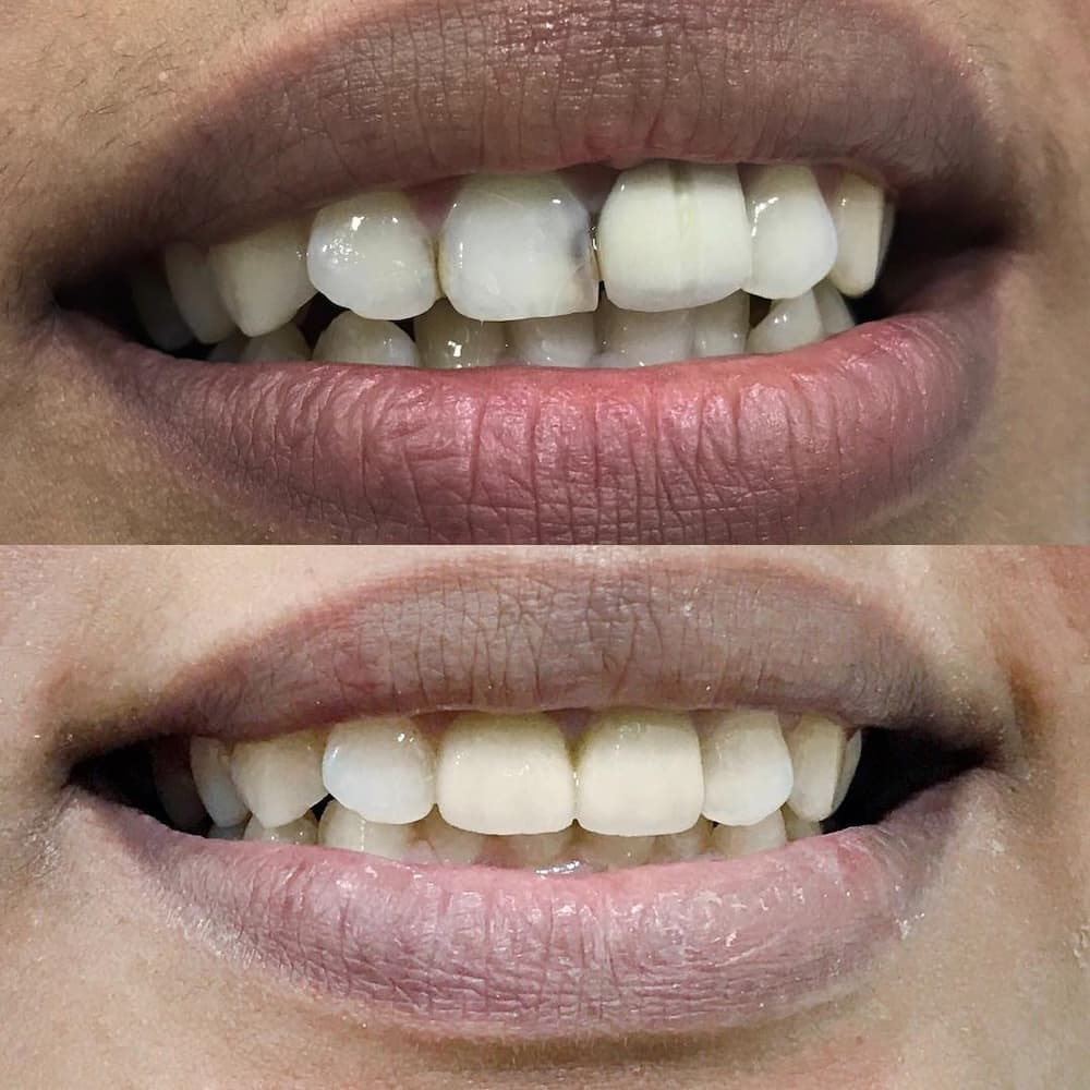 Everything you need to know about teeth whitening in South Africa