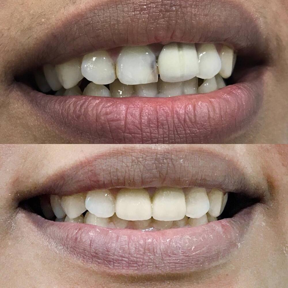 Everything you need to know about teeth whitening in South ...