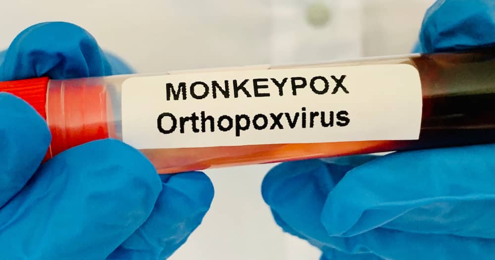 Fact check, Monkeypox, Vaids, AIDS, shingles