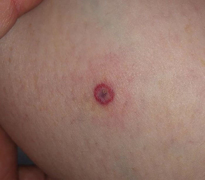 Tick bite fever causes, symptoms and treatment